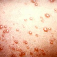Chickenpox in adults: complications