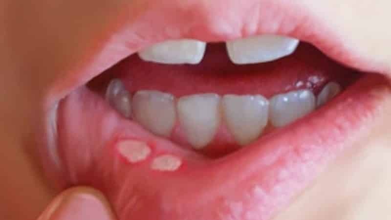 cómo deshacerse de llagas en la boca para siempre