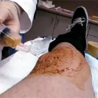 Hemartróza kolenného kĺbu