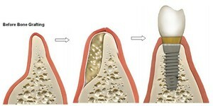 Proces obnovy zubů kostí