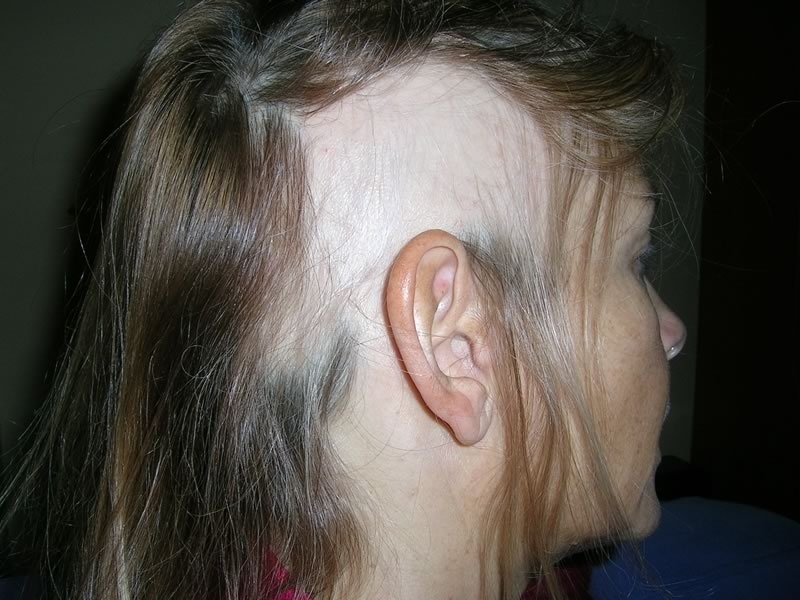 Simptomi alopecija areata