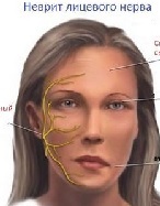 Inflammation of the facial nerve