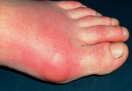 Complications of gout
