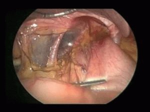 Pancreatitis operatie