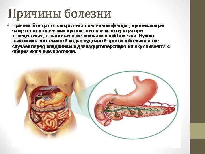 Príčiny akútnej pankreatitídy