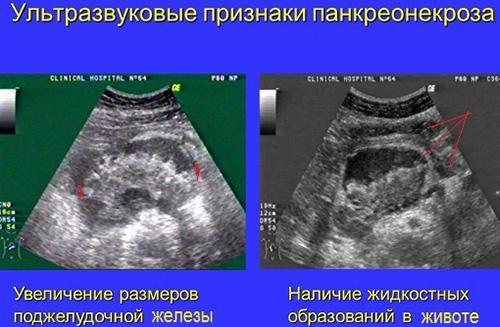 Zobrazenie pankreatickej nekrózy na ultrazvuku