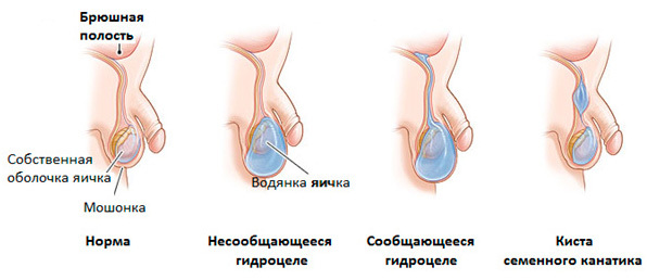 Ursachen und Behandlung von dropsy testis( hydrocele)