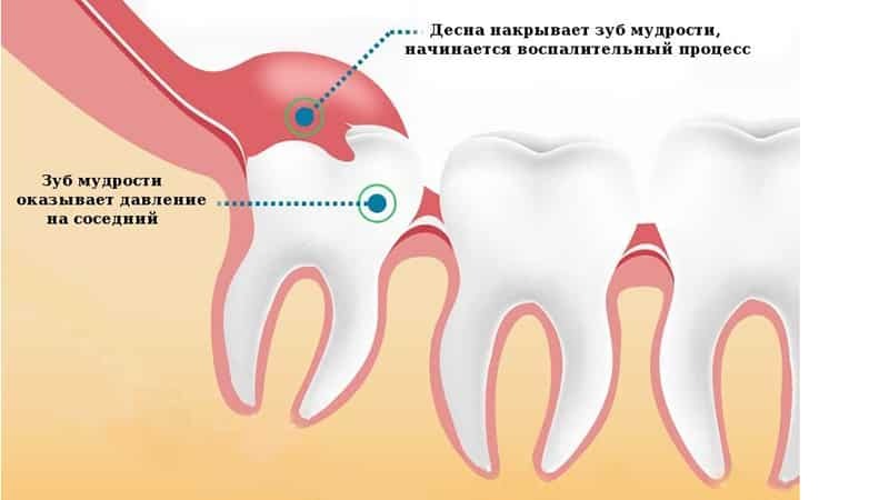 Entzündetes Zahnfleisch um Weisheitszähne, Behandlung