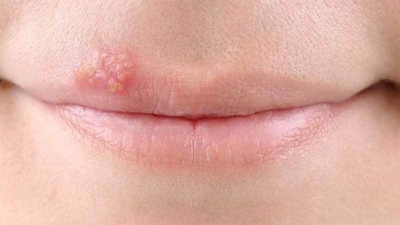 pengobatan herpes pada foto bibir