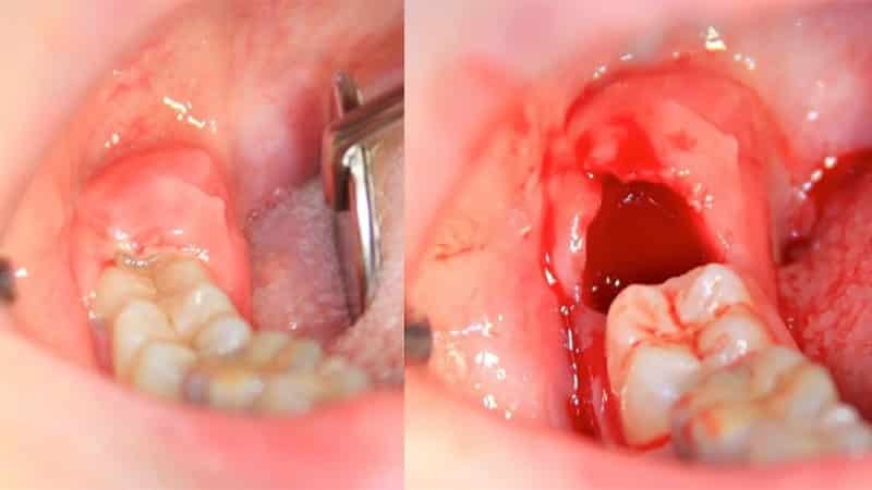 bol bolne desni poslije vađenja zuba, što ga čini bol u desnima