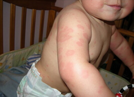 Alergija na fotografije tijela