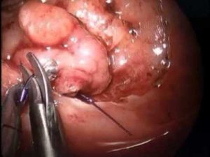 Sigmoïde colonpoliep: oorzaken, symptomen, diagnose en behandeling