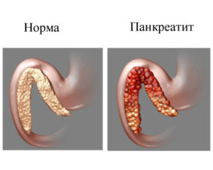 Pancreatitis enfermedad