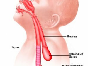 Atresia of the esophagus