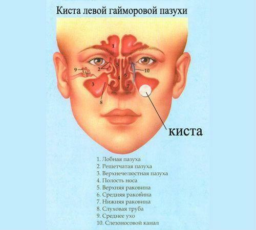cista maksilarnog sinusa simptoma