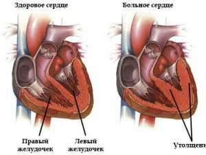 Descrição da hipertrofia cardíaca