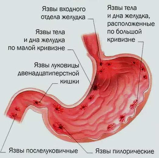As opções mais comuns para a localização de úlceras gástricas