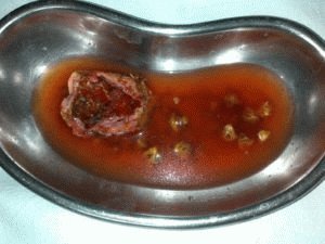 Tratamento da doença do cálculo biliar sem cirurgia: todos os métodos, da dieta à medicação