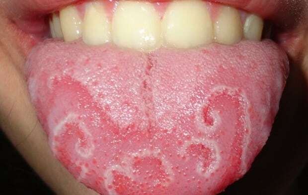 warum die Spitze der Zunge rot und sticht als heilen, was