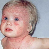 Dermatite alérgica em fotos de crianças