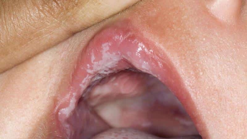 Auf den Lippen des weißen Punktes: Foto, Ursachen, Behandlung