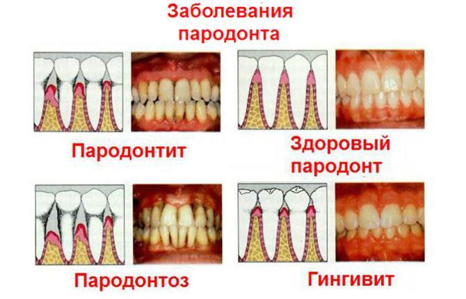 Tandvleesziekte