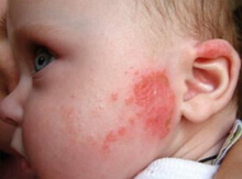 Fotos de sintomas de alergia