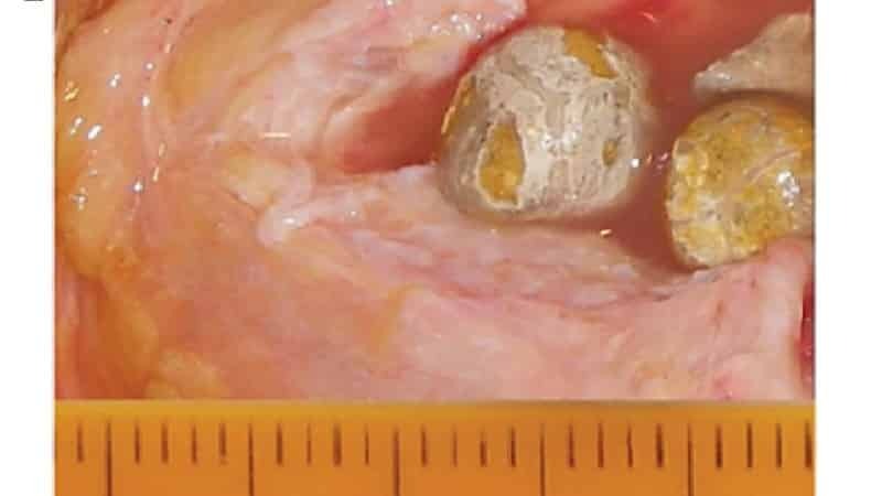 Pedra na glândula salivar: sintomas e tratamento ptyalolithiasis