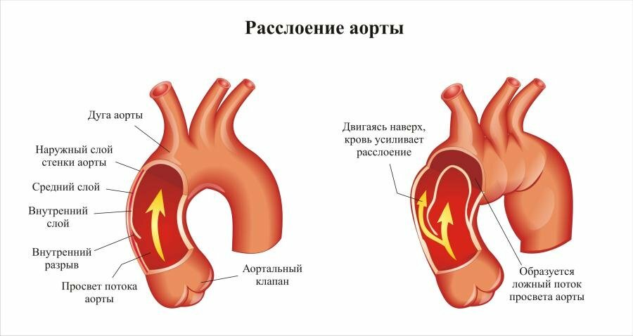 Aortic dissection: symptoms and first aid