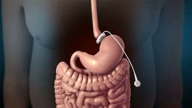 For what and how is the gastric banding performed?