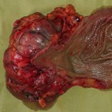 Gastrointestinal stromal tumor of the stomach