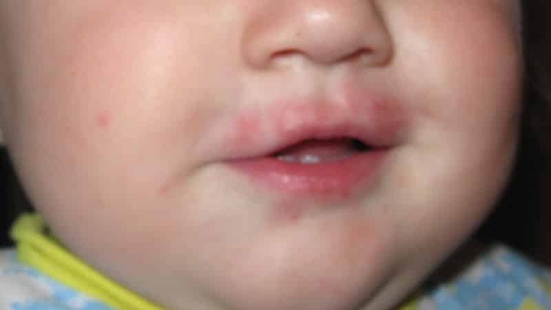 Herpes an der Lippe eines Kindes: die Behandlung bei Säuglingen