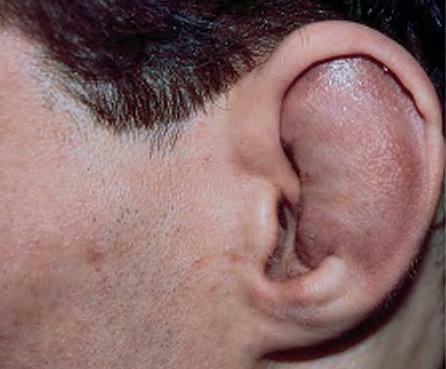 Hematom i øret: symptomer og behandling