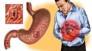 Inflammation de la muqueuse de l'estomac