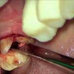 How the wisdom tooth is removed