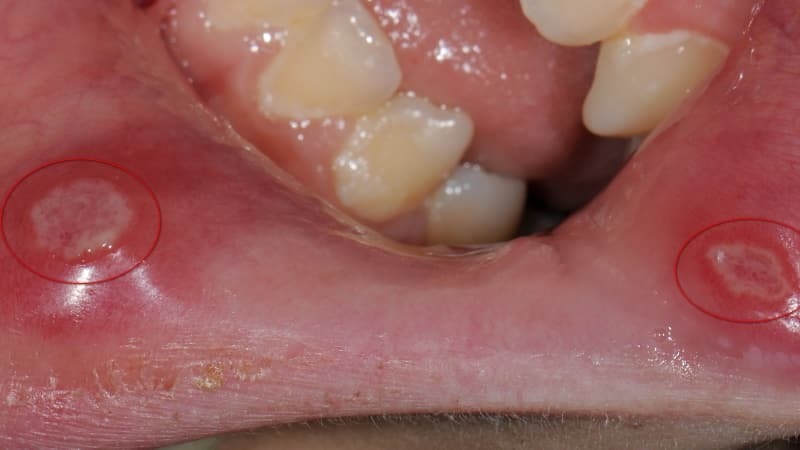 dari bagaimana memperlakukan luka di mulut menyebabkan pengobatan Foto