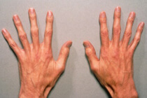 Marfan's Syndrome