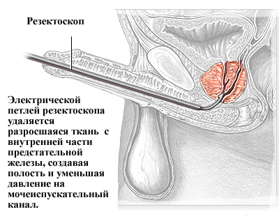 Transurethral resection of prostate adenoma( TUR) - preparation for surgery, consequences