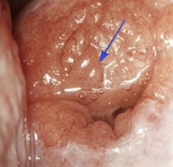 Ectropion van cervix uteri