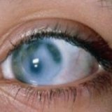 Trattamento dei rimedi popolari per il glaucoma