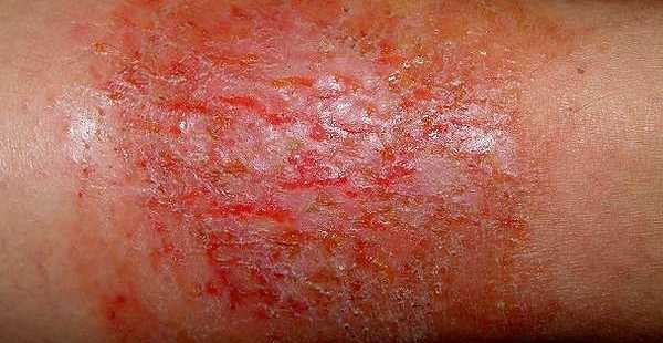 krónikus ekcémás dermatitis