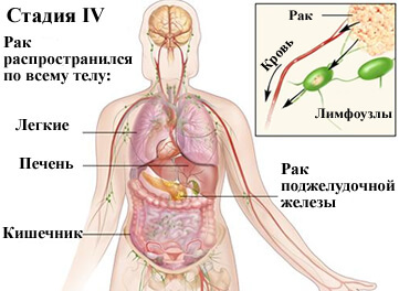4-stage cancer of the pancreas
