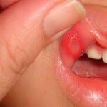 Um abscesso na boca