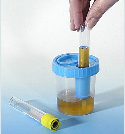 testovi urina: vrste i rezultati dekodiranja