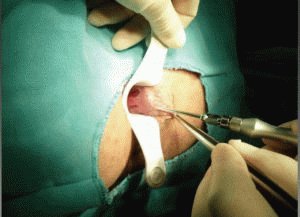 Het effect van de laser op de hemorrhoidale knobbel