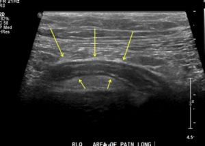Apendicitis na ultrazvoku