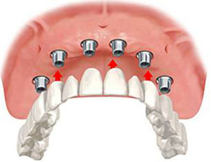 Jellemzői implantológiai és maga előnye és hátránya, bizonyos esetekben lehet szerelni a fogak implantátumok