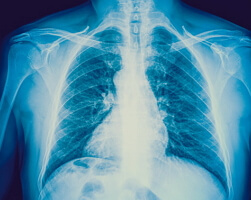 Intersticijska upala pluća