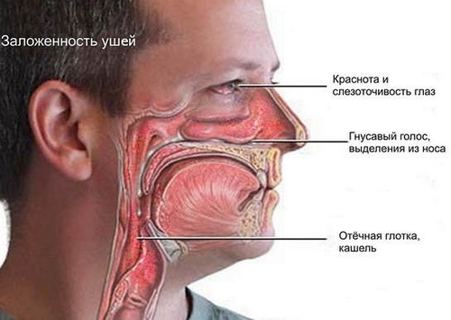 Symptoms of an allergic rhinitis