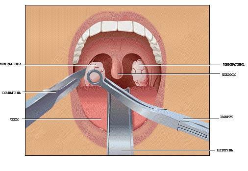 Tonsils eitrige Kork Behandlung